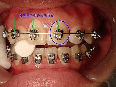 自鎖式矯正器 Slb Bracket 的槽溝 矯正醫師應該多注意其清潔 崇愛牙醫診所 資料重建中 歡迎新舊朋友 痞客邦