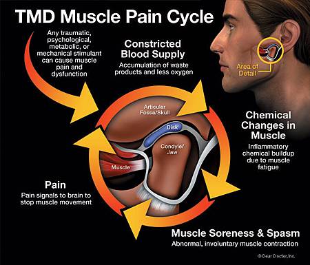 tmd-muscle-pain-cycle-tmj