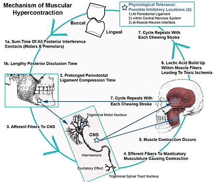 TMJ%20Pain%20Mechanism-resized-600