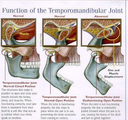 tmj-chart