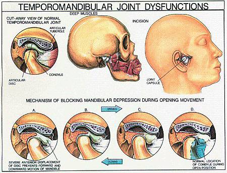 tmj_dysfunctions