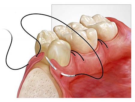 large_V4367---suture