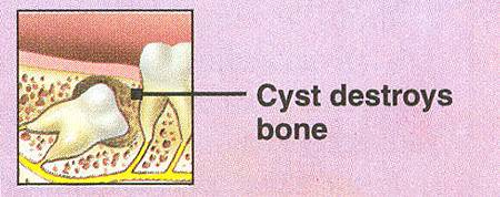 wisdom%20teeth%20removal%203