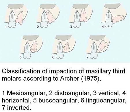 Wisdom%20Teeth%2005%20upper%208%20clasification