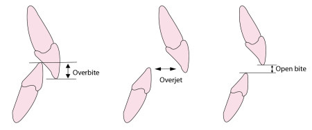 overbite-overjet-open-bite1-450x188