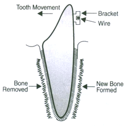 HOW-DO-BRACES-WORK