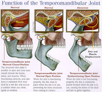 tmj-disorder