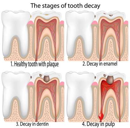 stages-tooth-decay