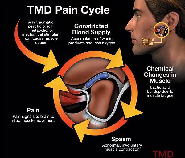 tmd-pain-cycle