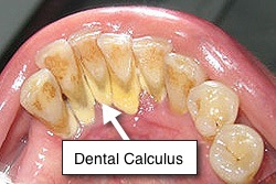 Dental-Tartar