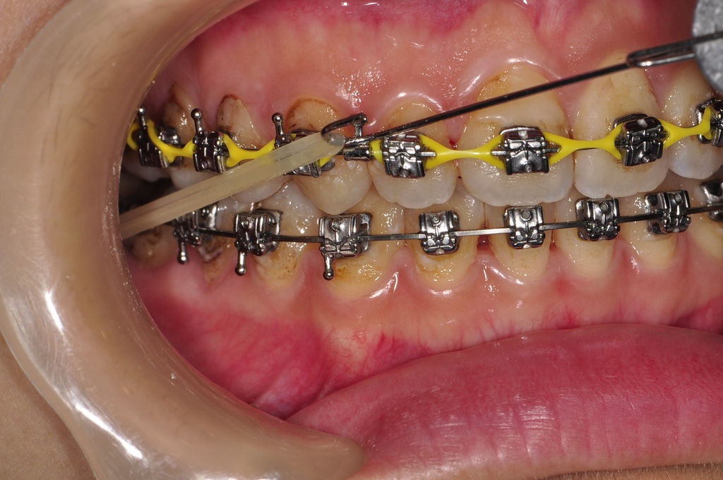 齒顎矯正每日一說 0006合適的牙齒矯正力量 Optimum Forces For Orthodontic Tooth Movement 崇愛牙醫診所 資料重建中 歡迎新舊朋友 痞客邦