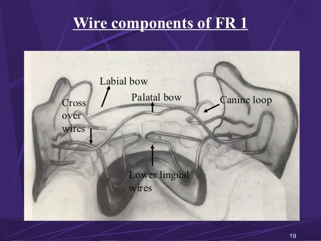 frankels-functional-regulator-certified-fixed-orthodontic-courses-by-indian-dental-academy-19-638.jpg