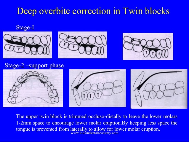 deep-overbite-correction-in-twinblocks-certified-fixed-orthodontic-courses-certified-fixed-orthodontic-courses-by-indian-dental-academy-2-638.jpg
