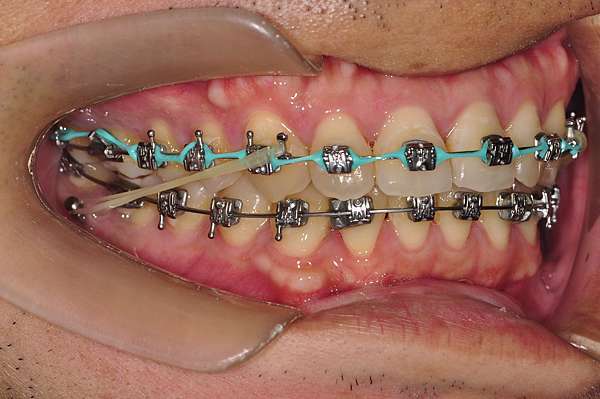 矯正當中戴用橡皮筋 Elastics 的注意事項有哪些 崇愛牙醫診所 資料重建中 歡迎新舊朋友 痞客邦