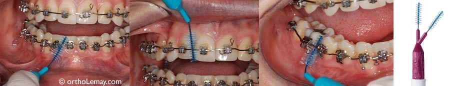 Proxabrush-brosse-orthodontique.jpg