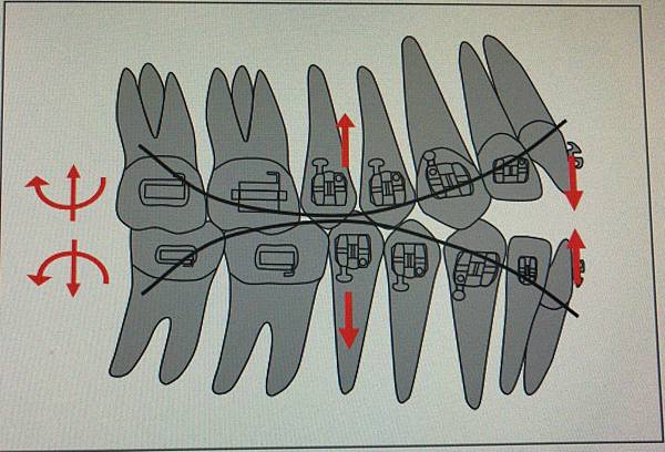 @齒顎矯正每日一說~~0154 curve of Spee(