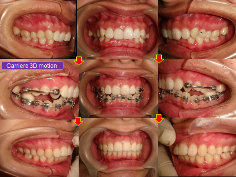 @利用carriere 3D motion改善深咬牙/牙列擁