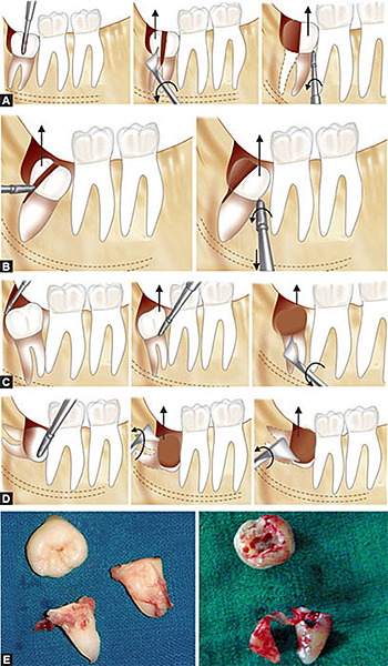 @齒顎矯正每日一說~~0220odontectomy(齒切除