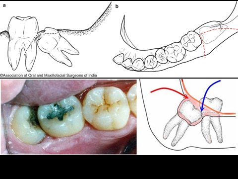 @齒顎矯正每日一說~~0220odontectomy(齒切除