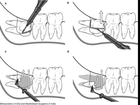 @齒顎矯正每日一說~~0220odontectomy(齒切除