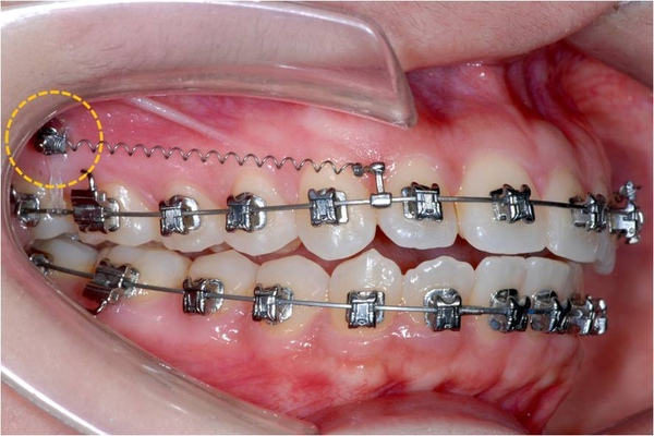 @齒顎矯正每日一說~~0226齒間骨釘(interdenta