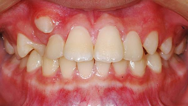 @(轉)牙齒矯正有哪些誤區