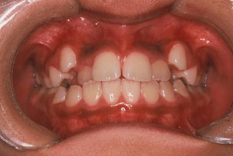 @(轉)走出牙齒矯正常見的誤區