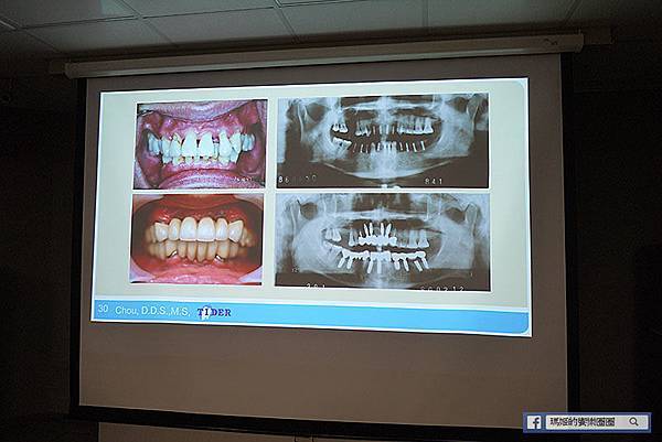 台北大安植牙推薦【來德牙醫診所】台北植牙權威周承澤醫師水雷射植牙發表會