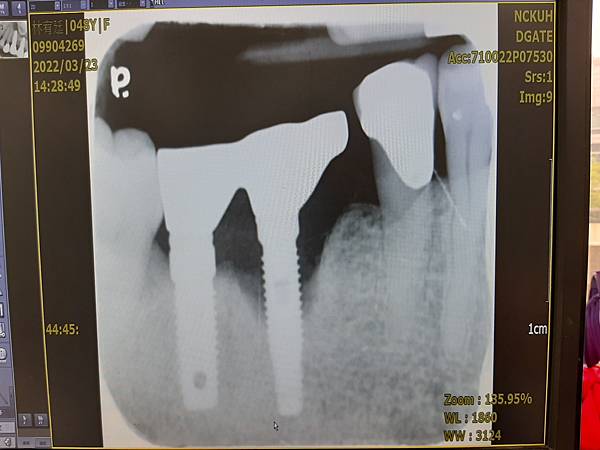 20220323 右下植牙 出問題了（在加拿大植牙的）