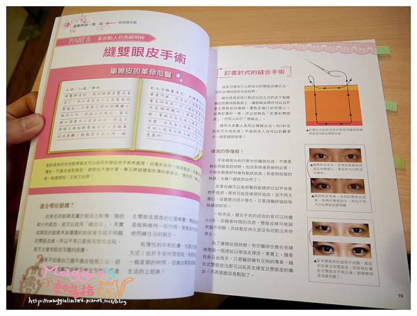 美麗爾縫雙眼皮 (7).JPG 美麗爾縫雙眼皮 (7).JPG