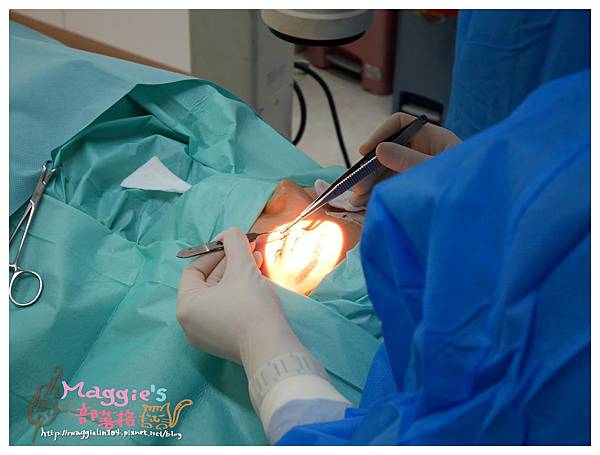 美麗爾縫雙眼皮 (25).JPG 美麗爾縫雙眼皮 (25).JPG