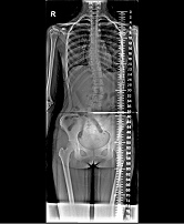 scoliosis Xray