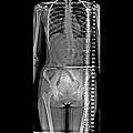 scoliosis Xray