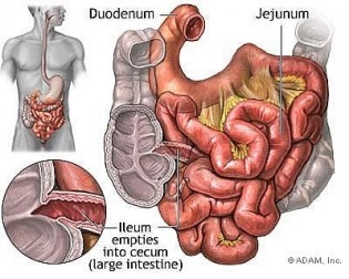 ileocecal-315x252