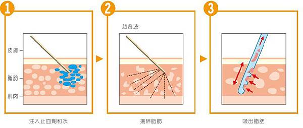 超音波抽脂