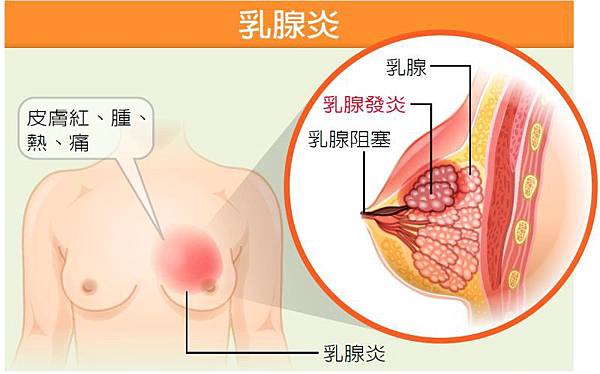 什麼是乳腺炎?什麼是乳腺阻塞?