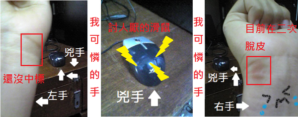 我可憐的手.png