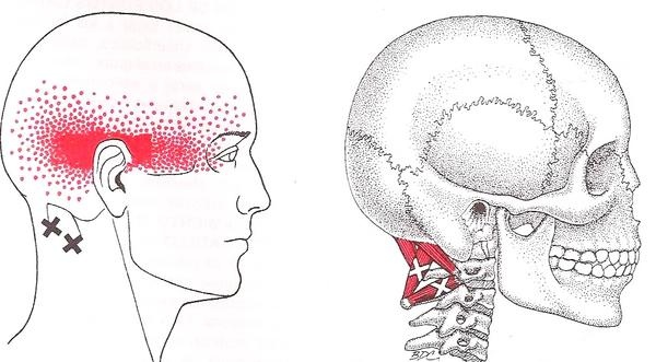 punto-gatillo-suboccipitales_grande.jpg