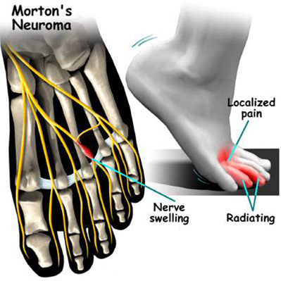 mortons_neuroma.jpg