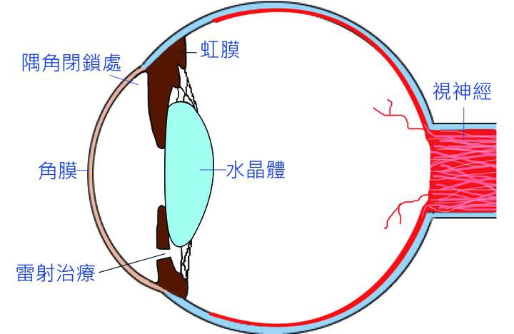 青光眼專欄 青光眼雷射治療知多少 專業醫師告訴你 視界密碼 醫學雜誌專刊 眼科醫學 近視 雷射 老花 遠視 白內障 青光眼 角膜移植 Review 痞客邦