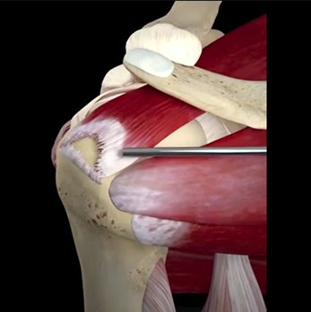 五十肩 復健一周年經驗談