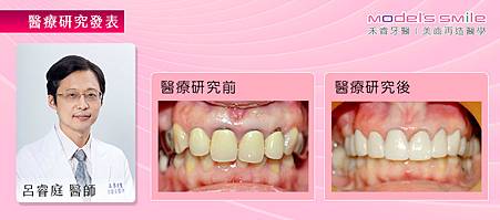 【微創牙周治療合併植牙】不當植牙險造成骨萎縮 重建術後咬合良好