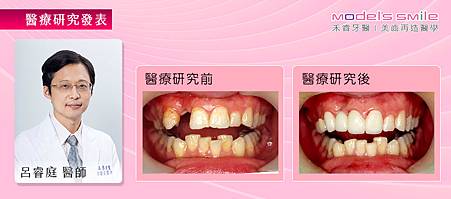 1.(植牙研究報告)【台北牙醫人工植牙案例】補缺牙兼美齒 揮別口罩小姐稱號