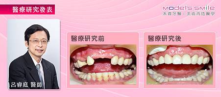 2.(植牙研究報告)【台北牙醫人工植牙即拔即種案例】快速植牙即拔即種 妙齡女恢復開心笑容