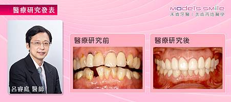 【台北植牙+星鑽全瓷冠案例】缺蛀牙面子不保 植牙美齒改頭換面雪恥