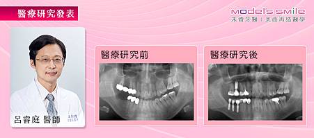 【台北雷射微創植牙案例】牙周發炎又缺牙 影響新婚婦受孕品質