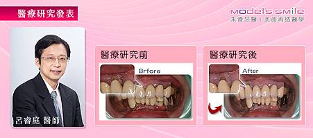 10.(牙周研究報告)【台北牙醫／牙周病水波雷射治療案例】牙周口臭壞親子關係 水波雷射治療助修復裂痕