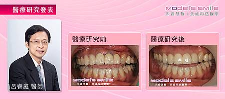 【台北牙醫舒眠植牙案例】金屬瓷牙惹禍 舒眠植牙輕鬆治好牙齦發黑紅腫