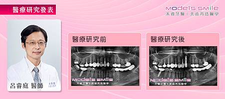 【台北牙醫微創植牙案例】假牙搖動心慌慌 微創植牙精確迅速更穩固