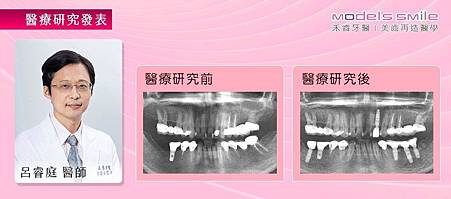 (植牙研究報告)【台北牙醫 人工植牙案例】舒眠結合微創植牙 舒緩情緒快速重建口腔.jpg